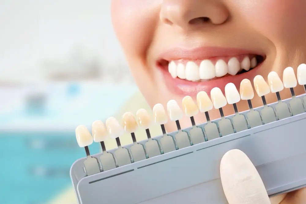 Veneers